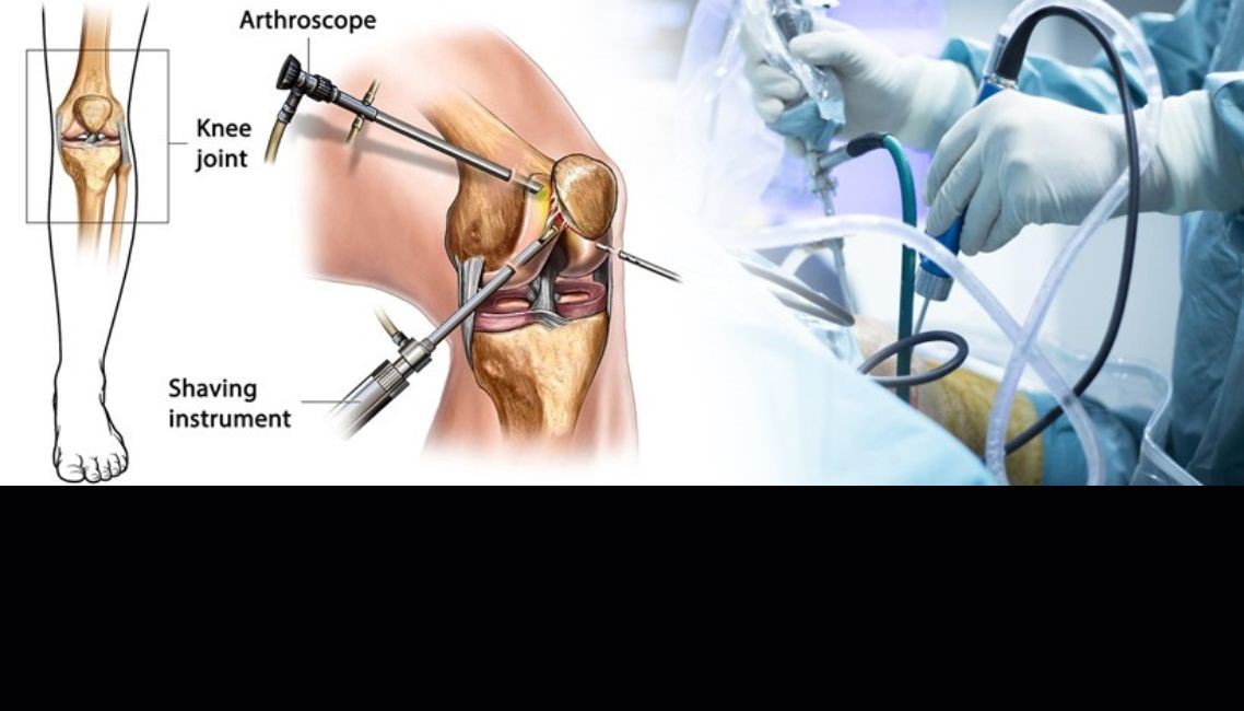 Knee Preservation and Arthroscopy in South Delhi